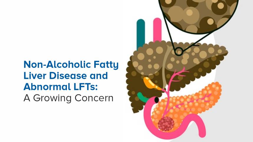 Non-Alcoholic Fatty Liver Disease and Abnormal LFTs: A Growing concern